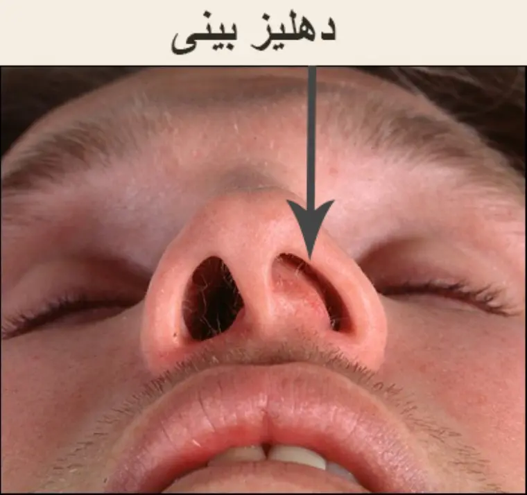 دهلیز-بینی