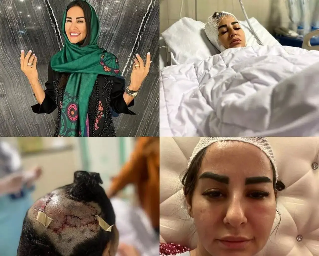 تصاویر زن جوان پس از حمله هولناک سـگ لاکچری | سرم جراحی شد و بدنم ۱۱۰ بخیه خورد | صاحب پیت‌ بول هیچ دلجویی و عیادتی از من نکرد