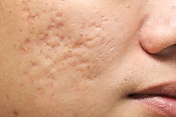 acne5-s
