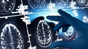 این داروی گیاهی مفید علیه آلزایمر را بشناسید