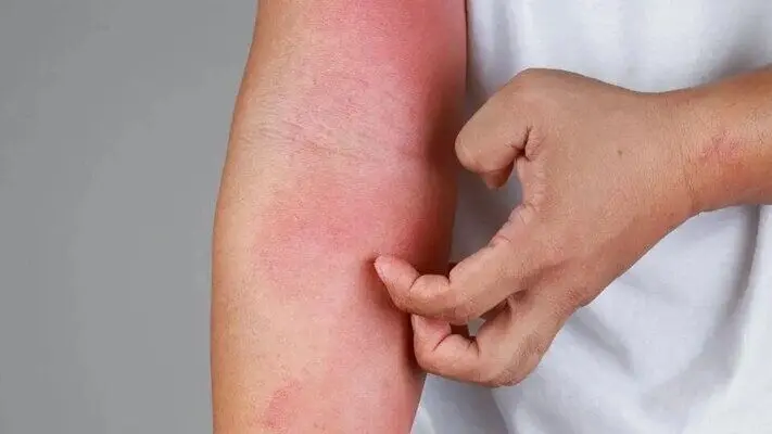 چگونه از پیشروی حساسیت و آلرژی در فصل بهار جلوگیری کنیم؟ 