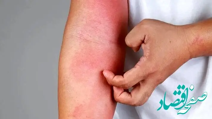 چگونه از پیشروی حساسیت و آلرژی در فصل بهار جلوگیری کنیم؟ 