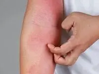 چگونه از پیشروی حساسیت و آلرژی در فصل بهار جلوگیری کنیم؟ 