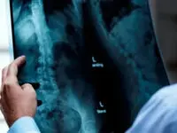 آیا پیوند نخاع می‌تواند فلج را درمان کند؟ ادعای تازه از مسکو