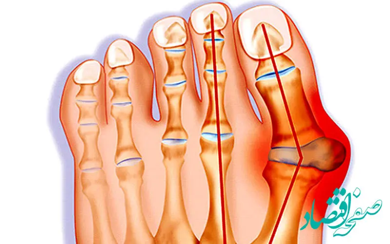 دلایل رایج تیر کشیدن انگشتان پا چیست؟ + درمان و پیشگیری