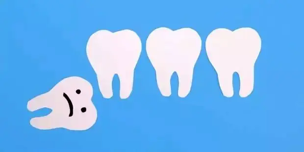 آیا باید حتما دندان عقل را بکشیم؟