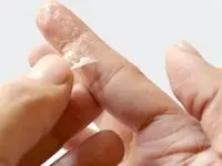 دلیل اصلی خشک شدن و ترک خوردن پوست چیست؟ 