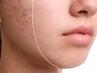 هزینه درمان جای جوش و اسکار در 1404 چقدر گران می‌شود؟