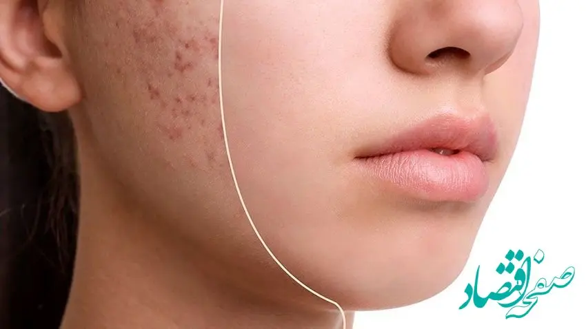 هزینه درمان جای جوش و اسکار در 1404 چقدر گران می‌شود؟