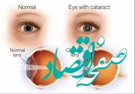 هر آنچه که نیاز است درباره آب مروارید بدانید