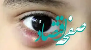 هرآنچه درباره کیست چشم باید بدانید
