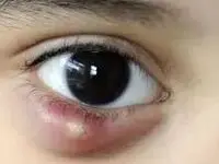 هرآنچه درباره کیست چشم باید بدانید