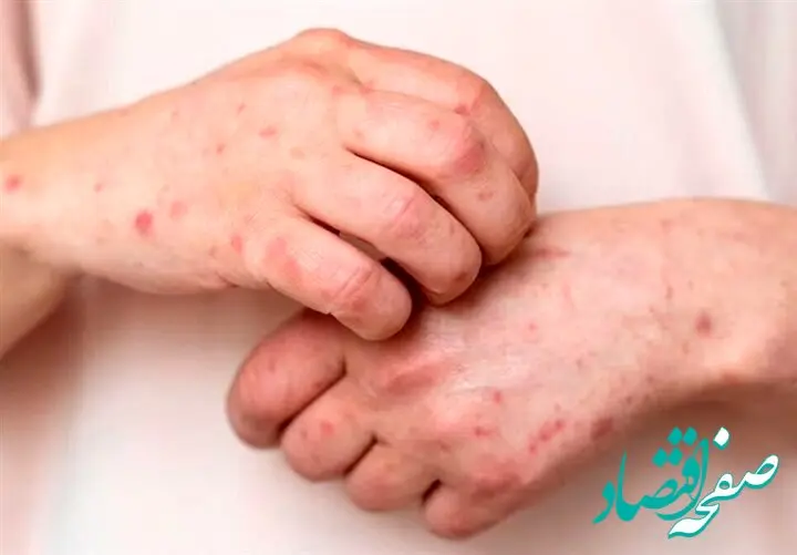 فوری؛ راه‌های انتقال یک ویروس که کودکان را درگیر می‌کند