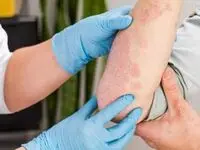 چه چیزهایی بیماری پسوریازیس را تشدید میکنه؟