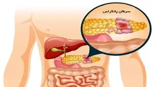 هشدار جدی پزشکی: این چهار علامت مرموز در پاهایتان می‌تواند نشانه اولیه سرطان مرگبار پانکراس باشد