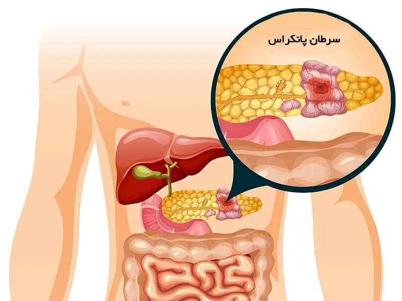 هشدار جدی پزشکی: این چهار علامت مرموز در پاهایتان می‌تواند نشانه اولیه سرطان مرگبار پانکراس باشد