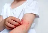 ۱۳ راز شوکه‌کننده درباره عوامل تشدید درماتیت آتوپیک که باید بدانید!