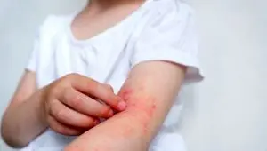 ۱۳ راز شوکه‌کننده درباره عوامل تشدید درماتیت آتوپیک که باید بدانید!