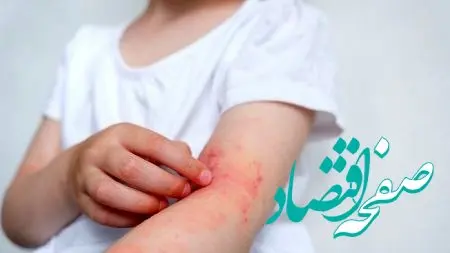 ۱۳ راز شوکه‌کننده درباره عوامل تشدید درماتیت آتوپیک که باید بدانید!