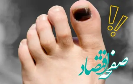 راه های درمان افتادن ناخن پا + علت و راه های پیشگیری