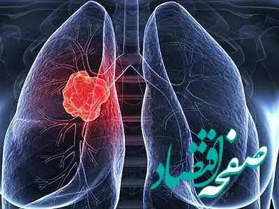 علائم سرطان ریه را بشناسیم