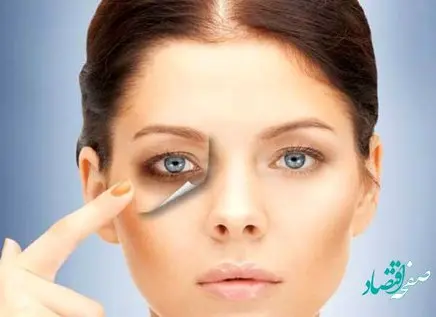 برای درمان سیاهی دور چشم چه کارهایی باید انجام دهیم؟