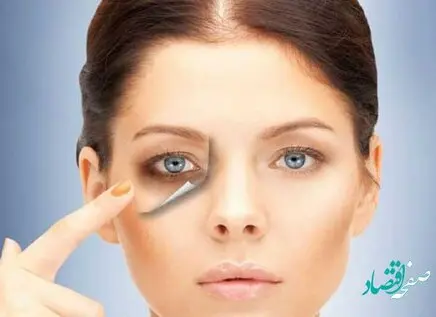 برای درمان سیاهی دور چشم چه کارهایی باید انجام دهیم؟