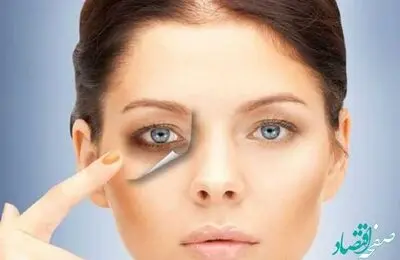 برای درمان سیاهی دور چشم چه کارهایی باید انجام دهیم؟