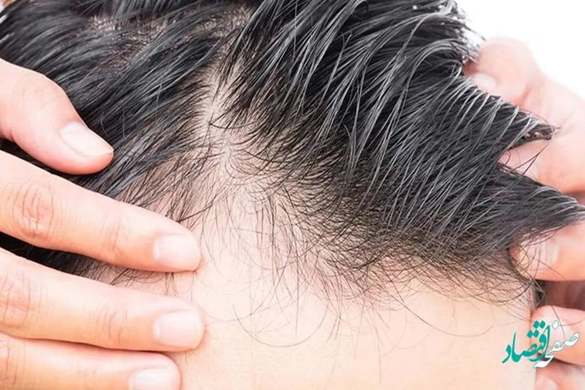 جزئیات چند راهکار ساده برای درمان ریزش مو + جزئیات کامل
