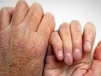آیا شیوع بیماری جذام در کشور حقیقت دارد؟ 