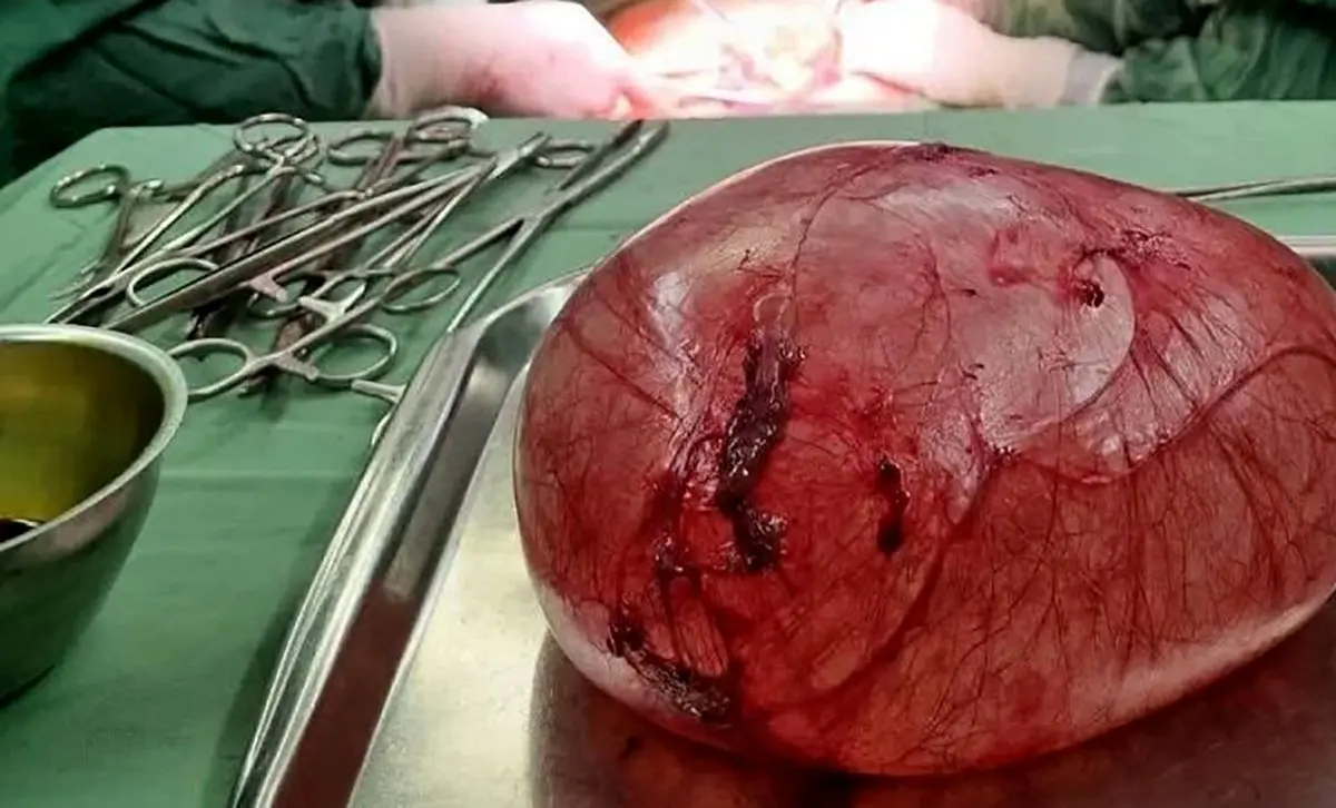 خارج کردن توده ای عجیب از شکم یک دختر ۱۸ ساله + جزئیات 