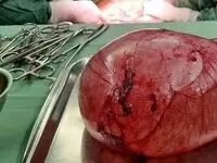 خارج کردن توده ای عجیب از شکم یک دختر ۱۸ ساله + جزئیات 