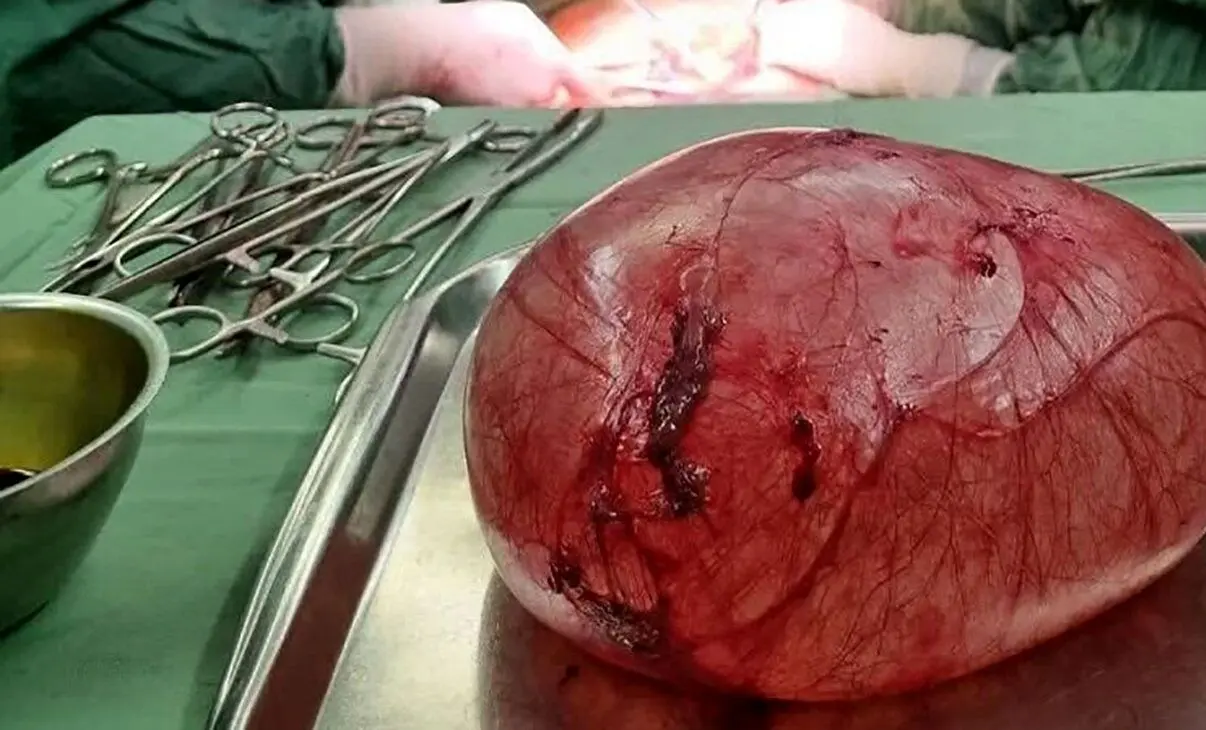 خارج کردن توده ای عجیب از شکم یک دختر ۱۸ ساله + جزئیات 