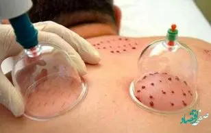 راهنمای تقویم حجامت ۱۴۰۲ و روزهای نامناسب برای حجامت ۱۴۰۲