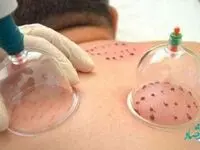 راهنمای تقویم حجامت ۱۴۰۲ و روزهای نامناسب برای حجامت ۱۴۰۲
