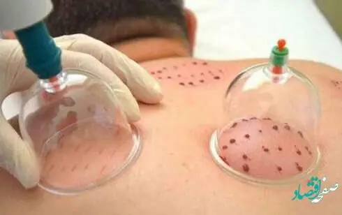 راهنمای تقویم حجامت ۱۴۰۲ و روزهای نامناسب برای حجامت ۱۴۰۲