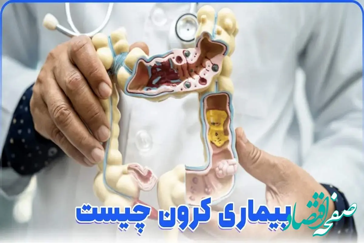 بیماری کرون چه علائمی دارد؟ + راه های درمان و تشخیص در زنان و مردان