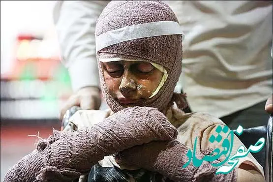 اگر در جنگ دچار سوختگی شدیم چه کنیم؟ + توضیحات کامل 