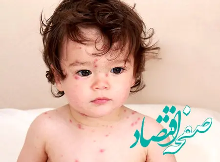 آبله مرغان چیست و درمان سریع آن در کودکان و بزرگسالان چگونه است؟