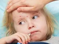 بخوانید | این افراد به مراقبت بیشتر در برابر سرخک نیاز دارند!
