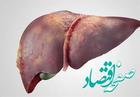 علت اصلی بروز کبد چرب + روش های درمان 