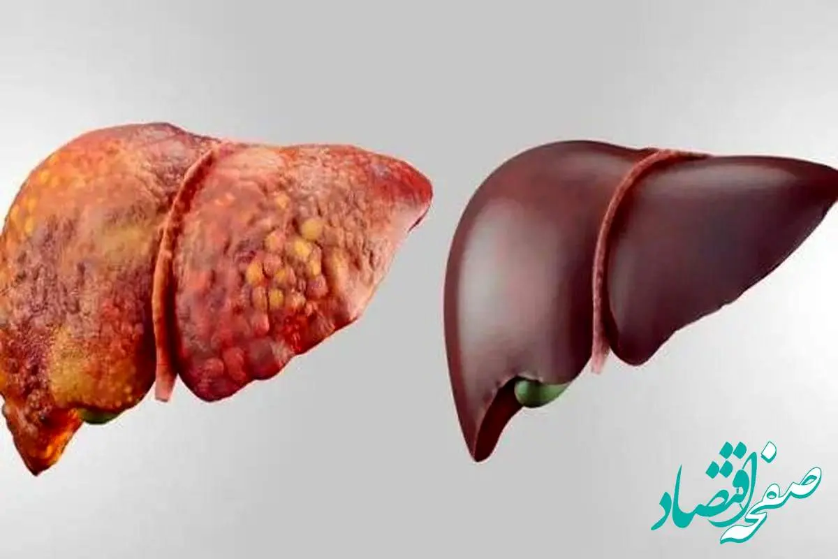 کبد چرب باعث کدام سرطان ها در بدن می شود؟ 