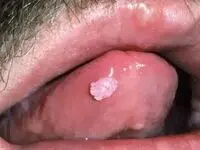 آیا زگیل تناسلی hpv از طریق بوسیدن و بزاق دهان منتقل می شود؟ + راه های پیشگیری