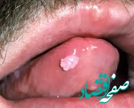 آیا زگیل تناسلی hpv از طریق بوسیدن و بزاق دهان منتقل می شود؟ + راه های پیشگیری
