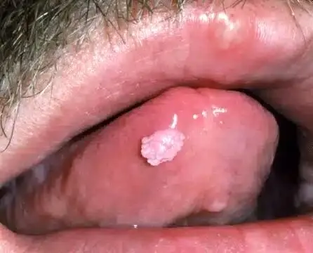 آیا زگیل تناسلی hpv از طریق بوسیدن و بزاق دهان منتقل می شود؟ + راه های پیشگیری