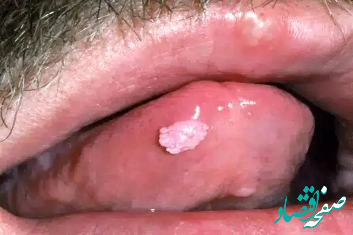 آیا زگیل تناسلی hpv از طریق بوسیدن و بزاق دهان منتقل می شود؟ + راه های پیشگیری