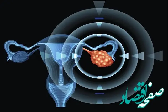 از تشخیص دیرهنگام سرطان تخمدان تا تأثیر شگفت‌انگیز فرزندآوری در کاهش تا ۷۰ درصدی ریسک