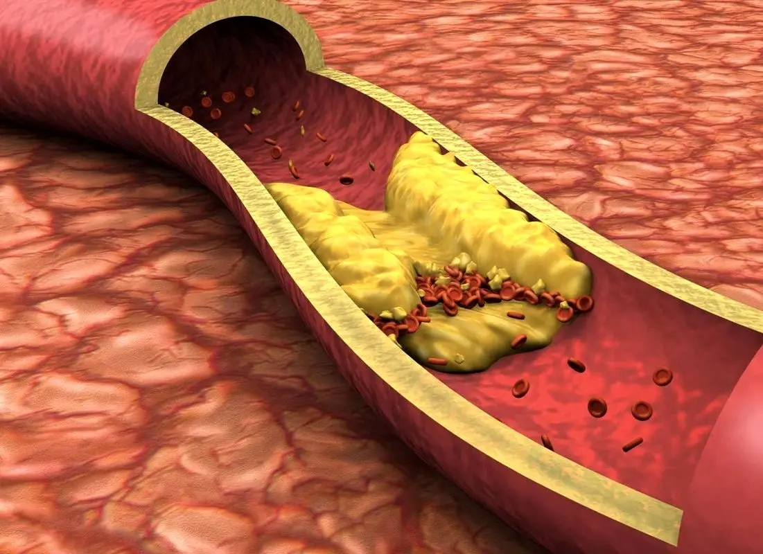 گرفتگی و مسدود شدن رگ های قلب چه علائمی دارد؟