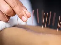 چگونه طب سوزنی به بازیابی صدای بیماران سکته مغزی کمک می کند؟ 
