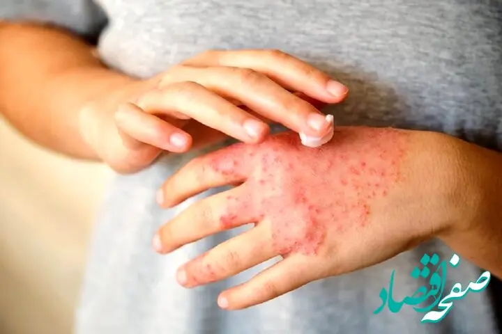 علت تشدید اگزما در نتیجه استرس کشف شد